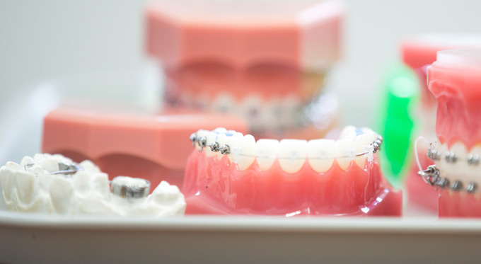 Ceramic braces