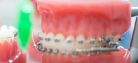 Self-ligating braces