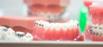 Upper ceramic braces
