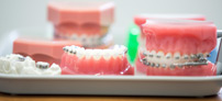 Caring for your braces