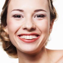 Self-ligating braces
