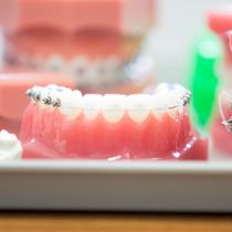 Clear braces