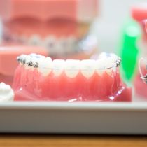 Clear braces