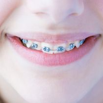 Metal braces