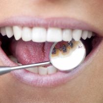 Lingual braces