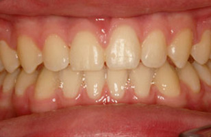 After orthodontic treatment