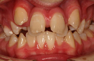 Before orthodontic treatment