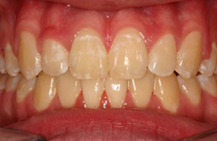 After orthodontic treatment