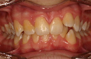 Before orthodontic treatment