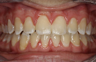 After orthodontic treatment