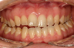 Before orthodontic treatment