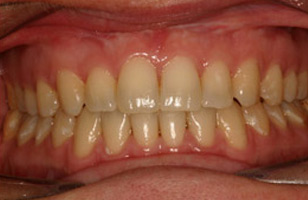 After orthodontic treatment