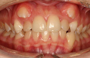 Before orthodontic treatment