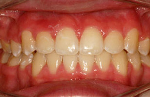 After orthodontic treatment