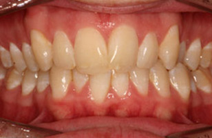 Before orthodontic treatment