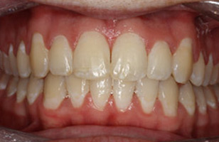 After orthodontic treatment