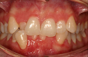 Before orthodontic treatment