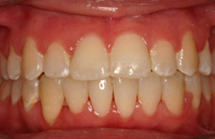 After orthodontic treatment