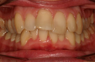 Before orthodontic treatment