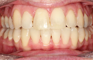 After orthodontic treatment