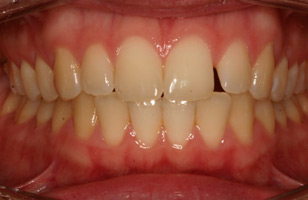 Before orthodontic treatment