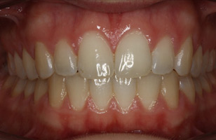 After orthodontic treatment