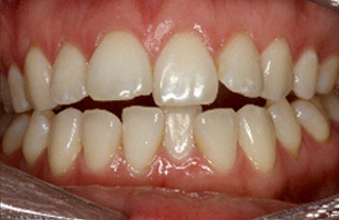 Before orthodontic treatment