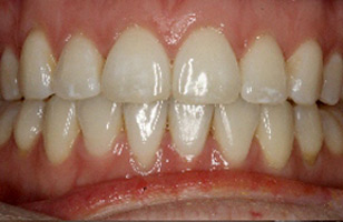 After orthodontic treatment