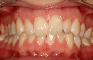 Before orthodontic treatment