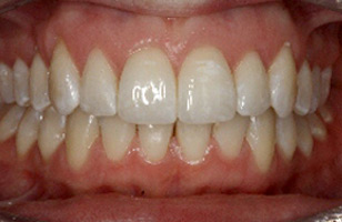 After orthodontic treatment