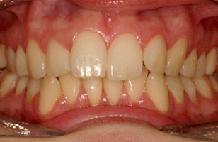Before orthodontic treatment