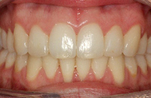 After orthodontic treatment