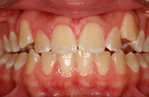 Before orthodontic treatment