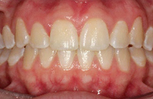 After orthodontic treatment