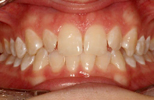 Before orthodontic treatment