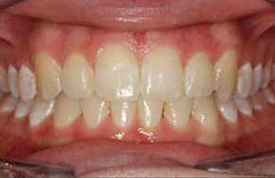 After orthodontic treatment