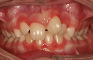 Before orthodontic treatment
