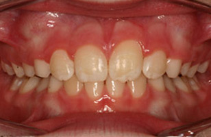 After orthodontic treatment
