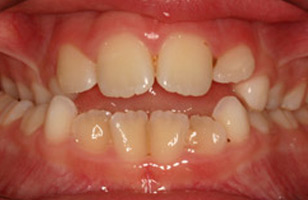 Before orthodontic treatment