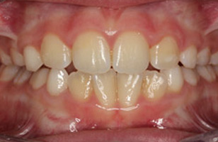 After orthodontic treatment