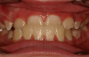 Before orthodontic treatment