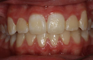 After orthodontic treatment