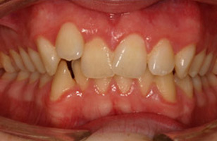Before orthodontic treatment
