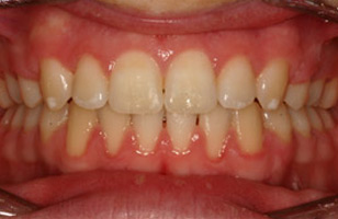 After orthodontic treatment