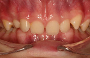 Before orthodontic treatment